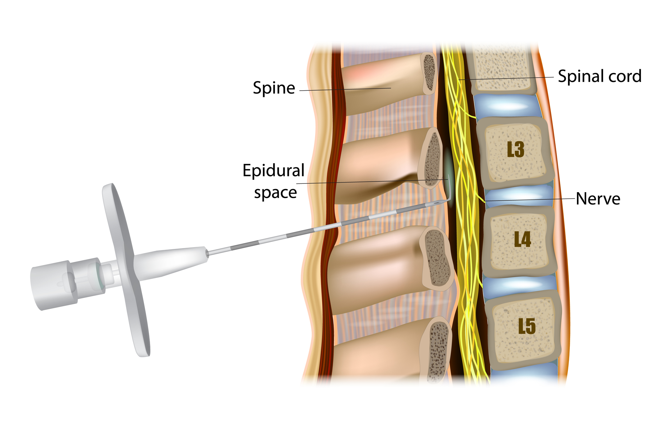 Lumbar Epidural Steroid Injection (Lumbar ESI)