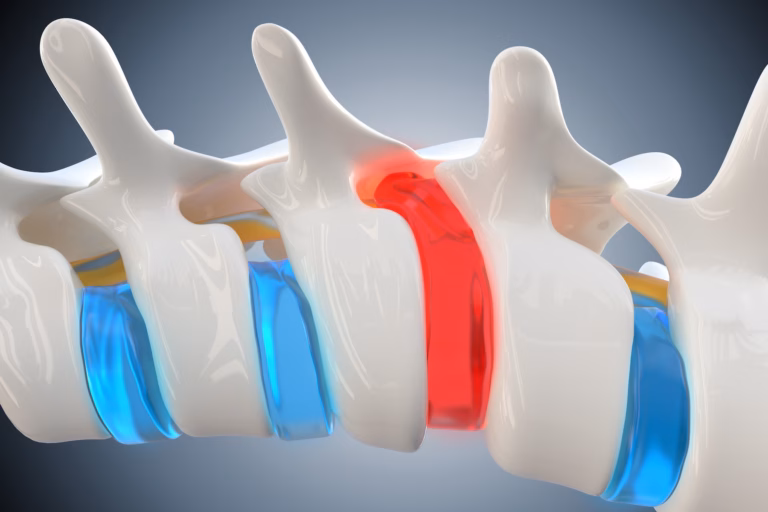 Herniated Disc (Bulging Disc, Disc Herniation)