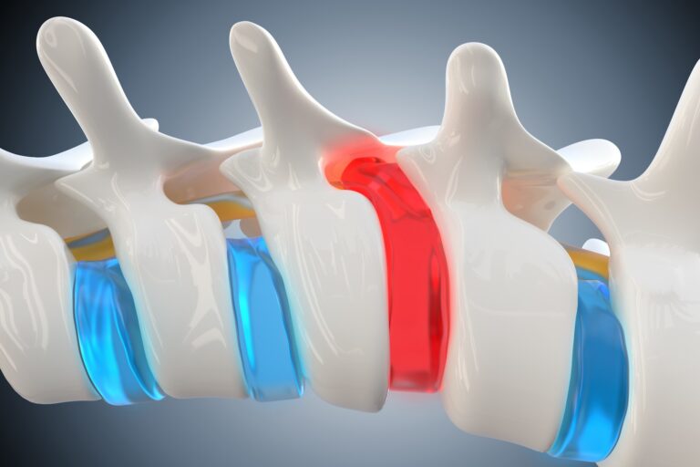 Herniated Disc (Bulging Disc, Disc Herniation)