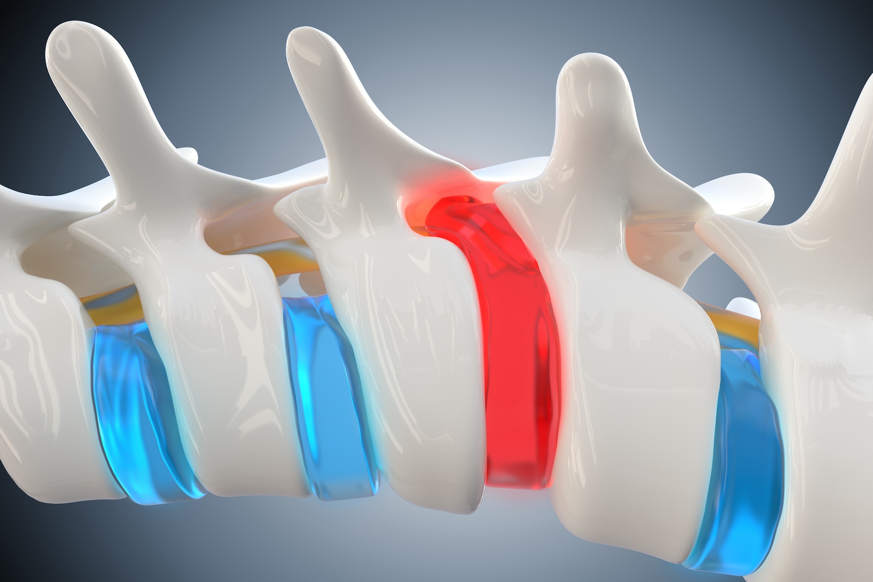 Herniated Disc