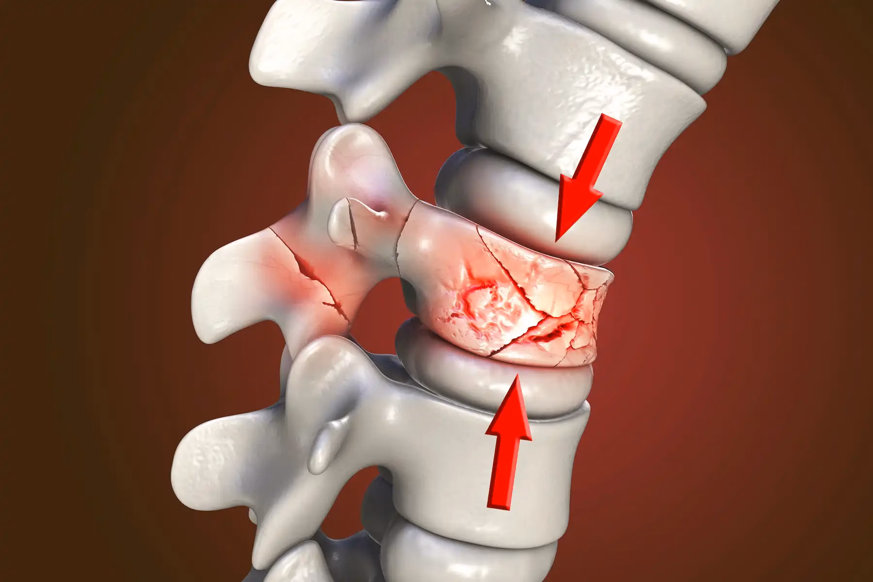Back Fracture/Break