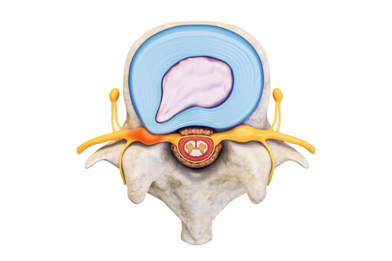 Lumbar Stenosis