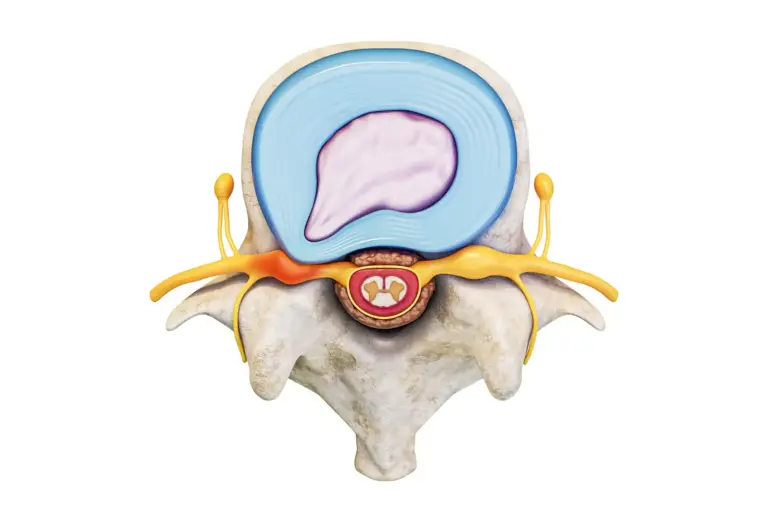 Lumbar Stenosis