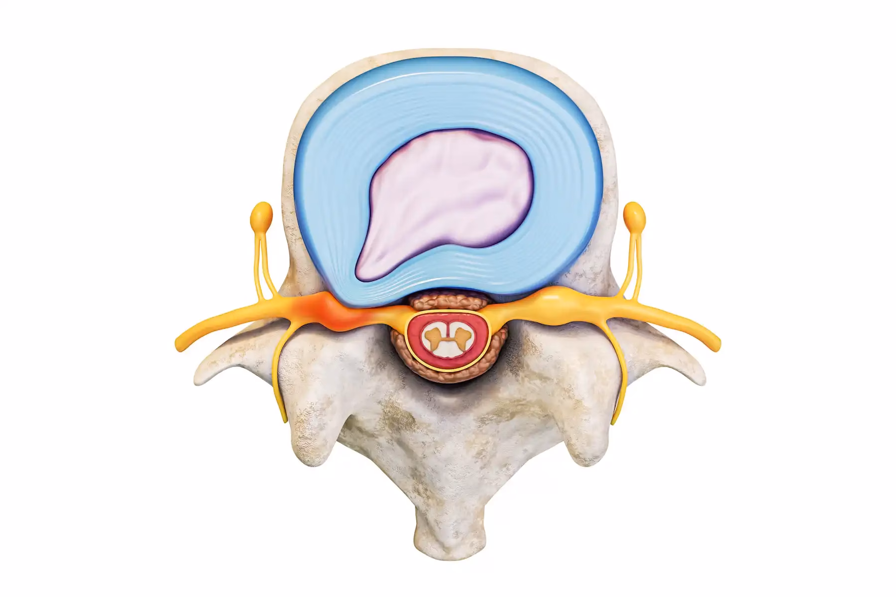 Lumbar Stenosis