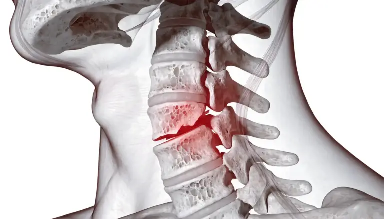 Neck Fracture/Broken Neck
