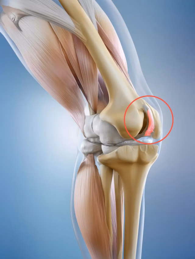 Patellofemoral Pain Syndrome