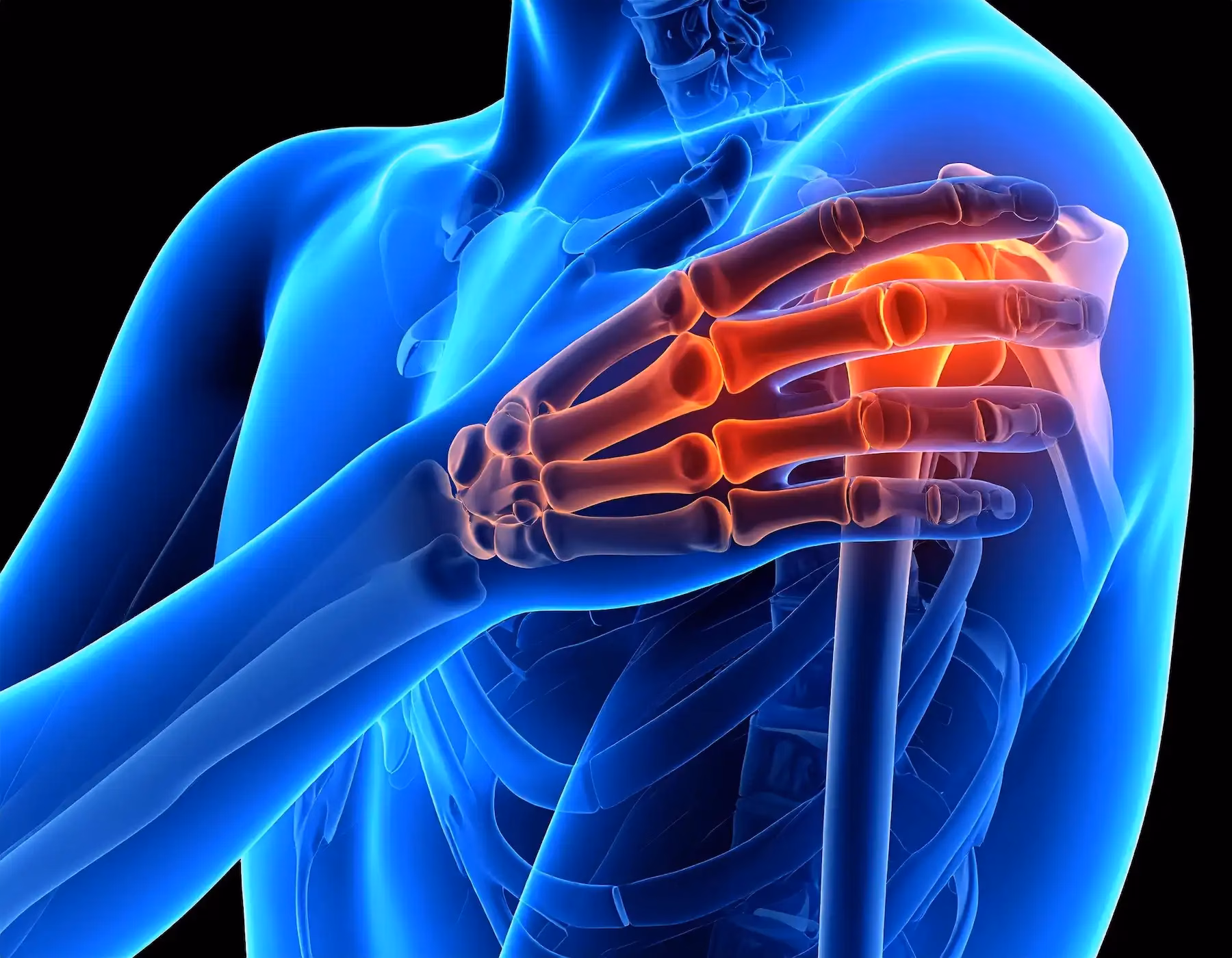 Biceps Tendinitis