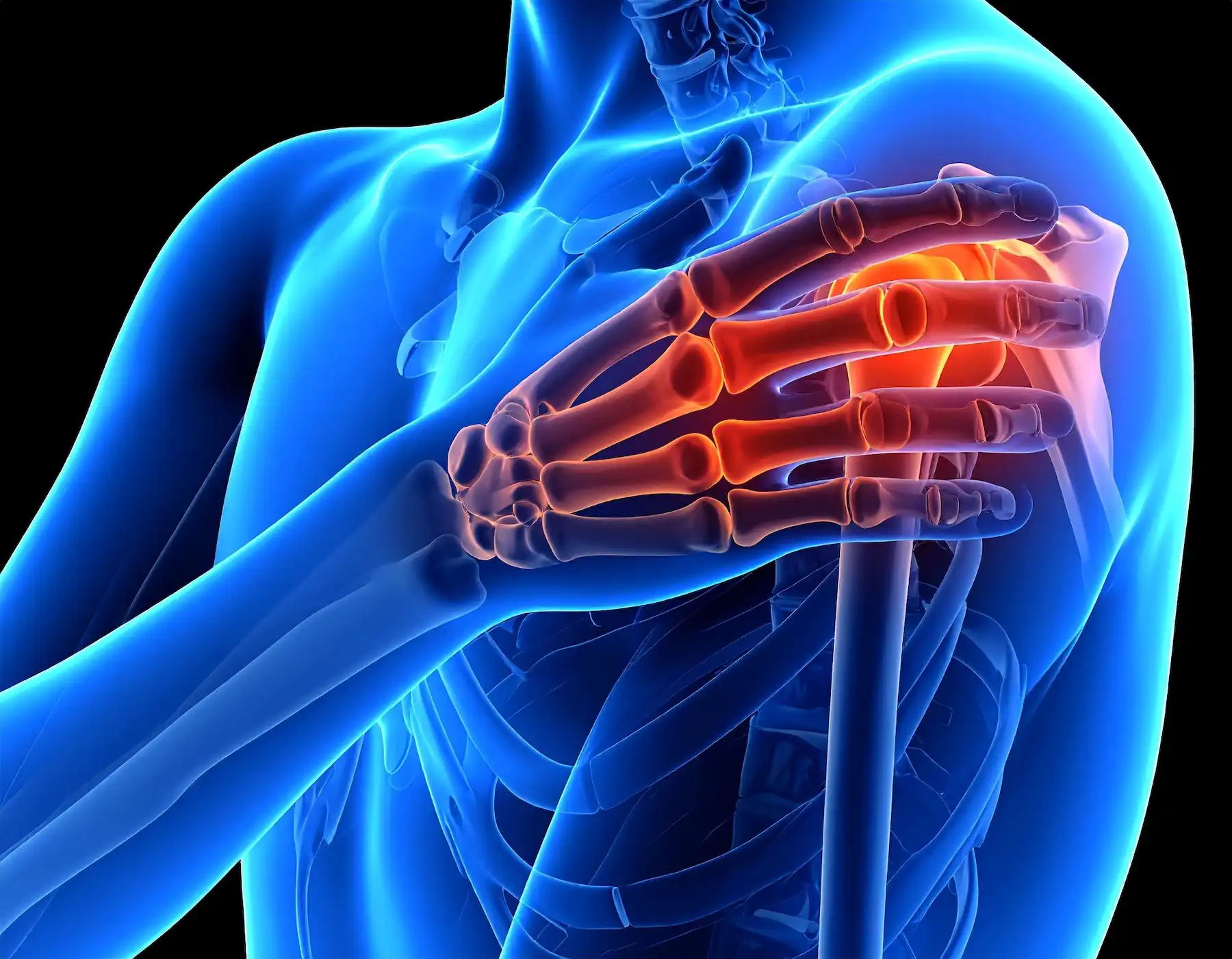 Biceps Tendinitis
