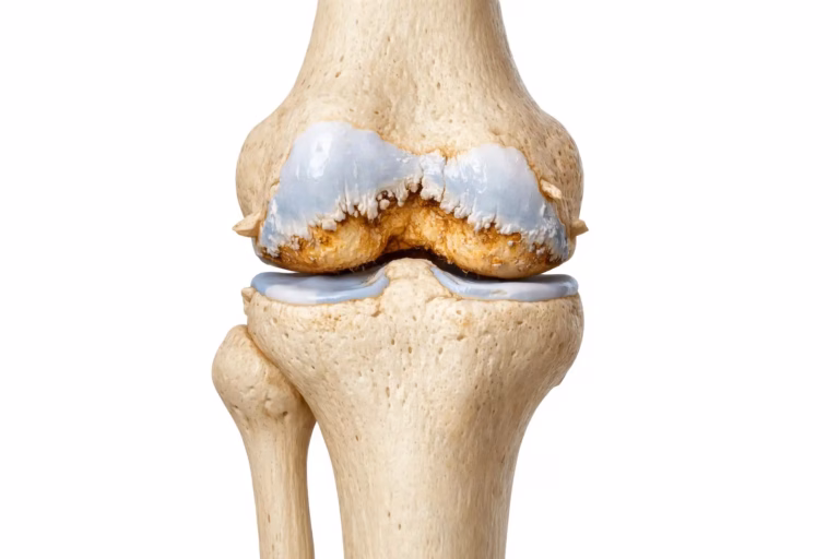 Knee Osteoarthritis