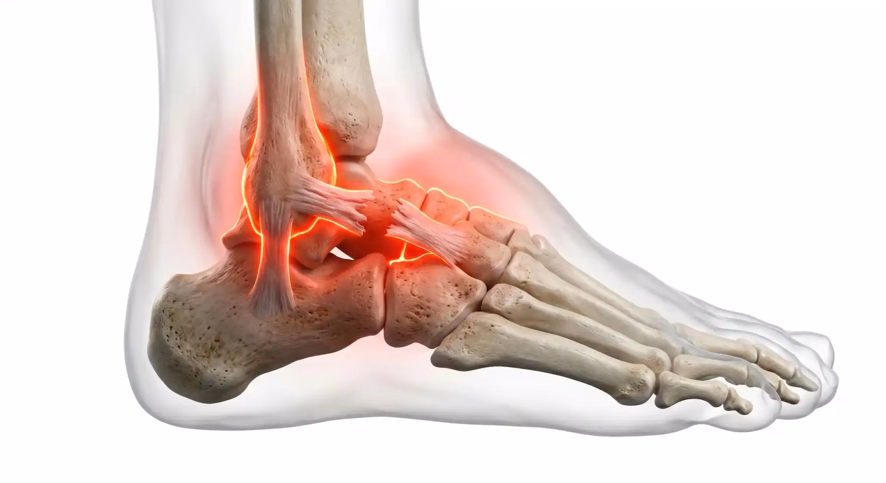 Ankle Sprain