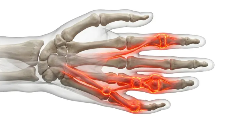 Dupuytren’s Contracture