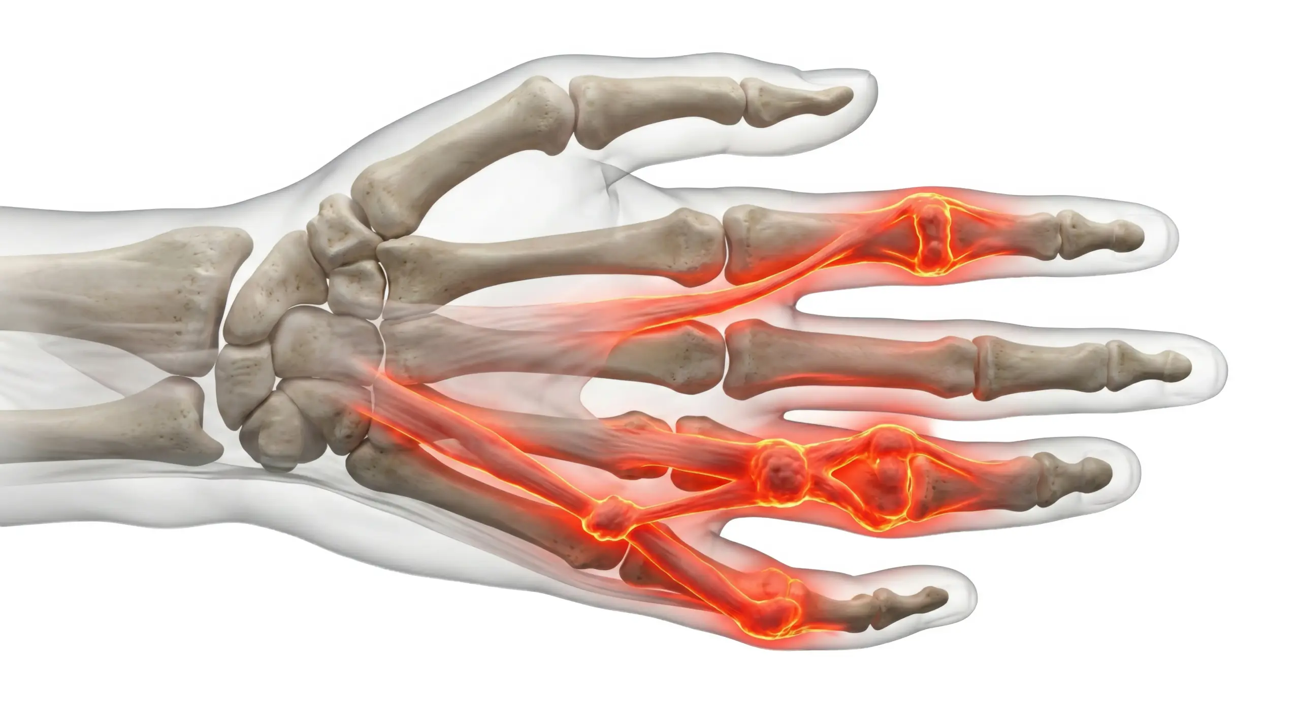 Dupuytren's Contracture