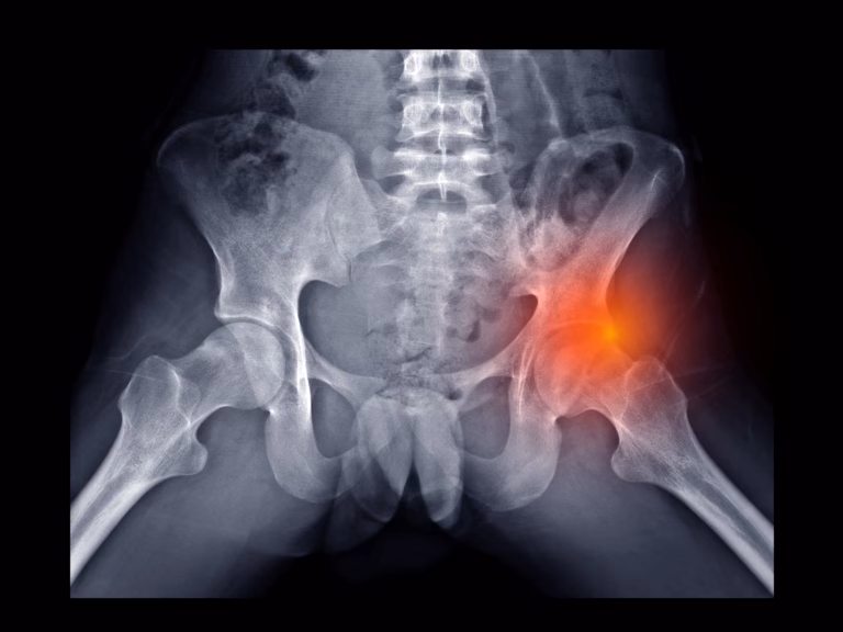 Femoroacetabular Impingement