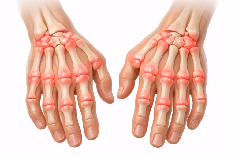 Hand Arthritis