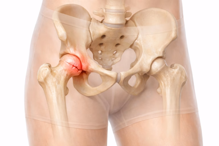Hip Fracture