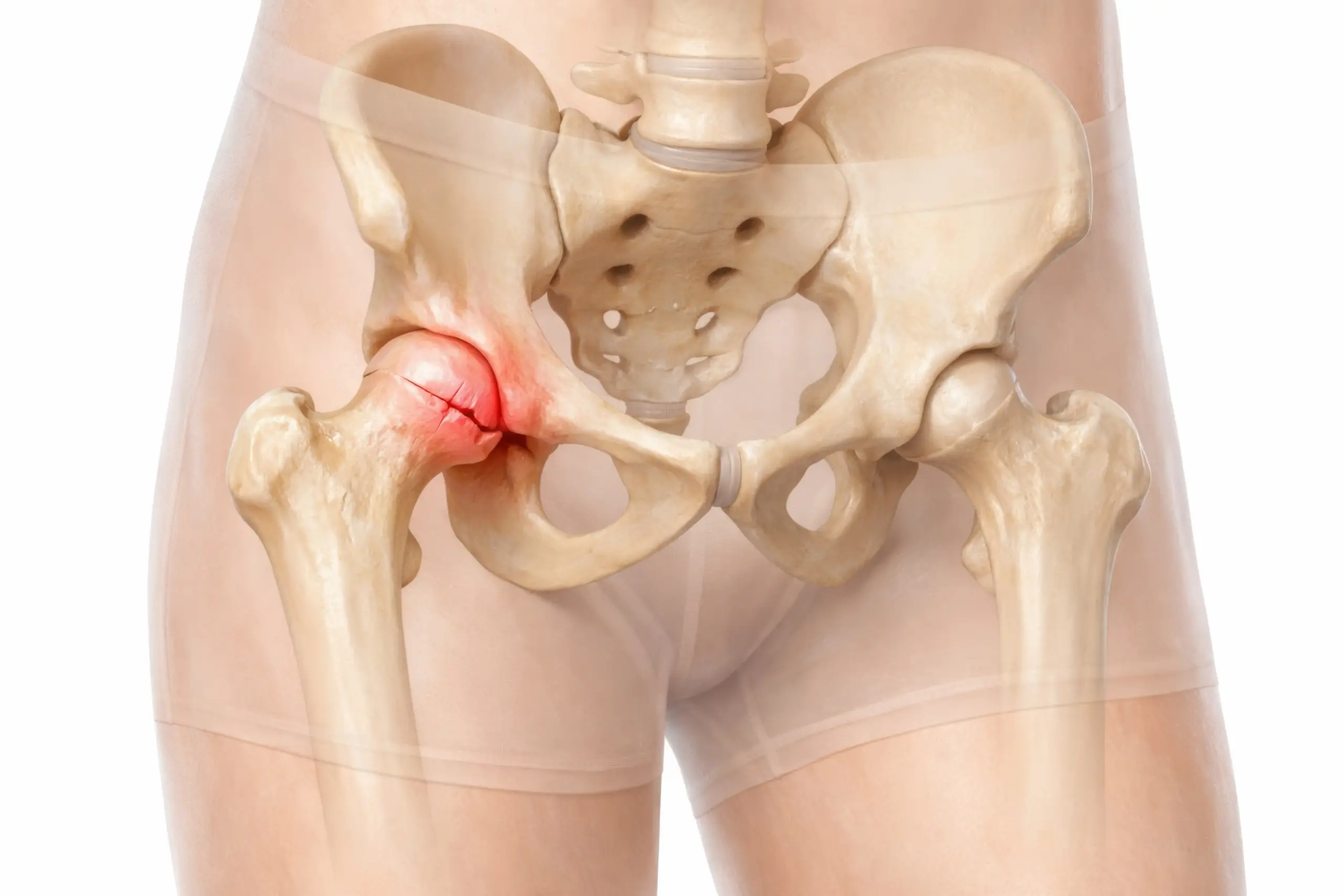 Hip Fracture