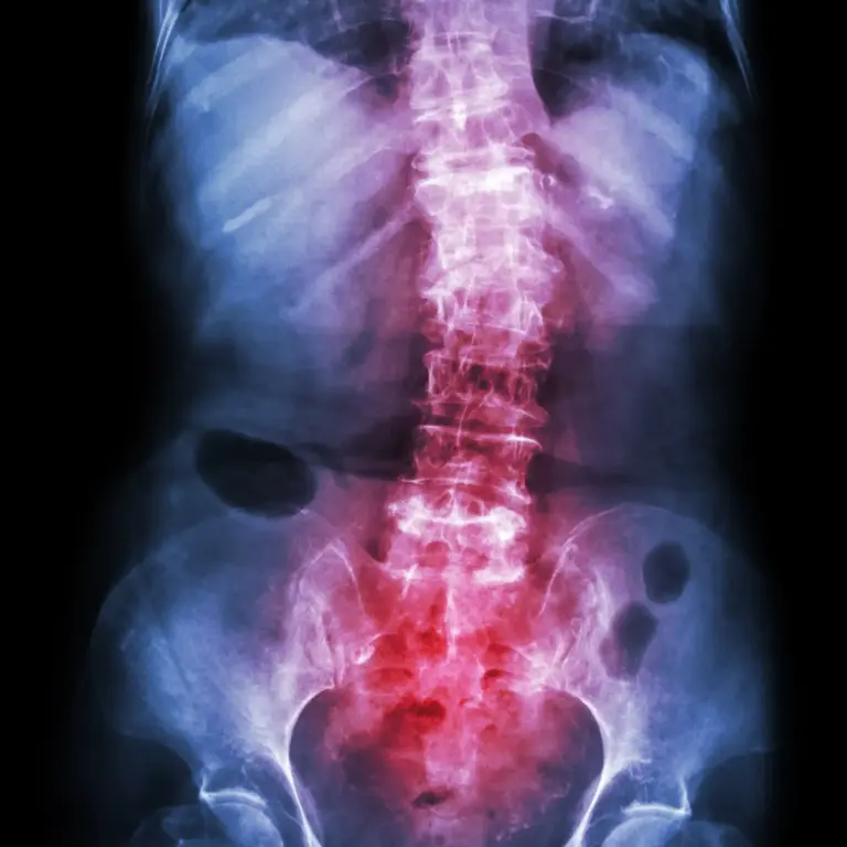 Scoliosis