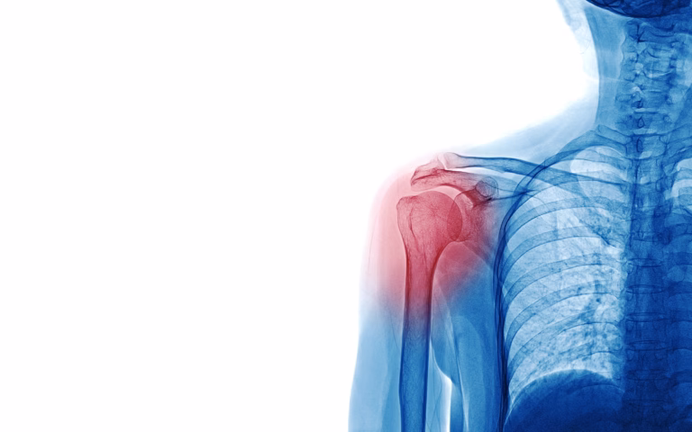 Shoulder Arthritis
