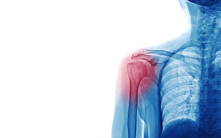 Shoulder Arthritis