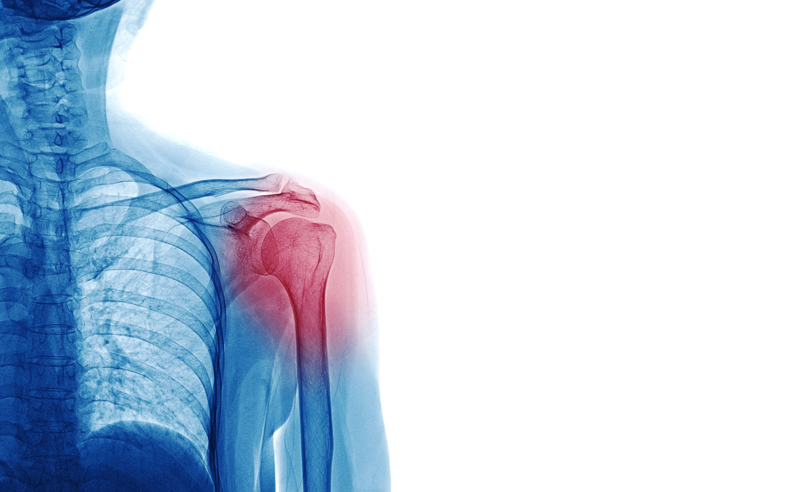 Shoulder Arthritis