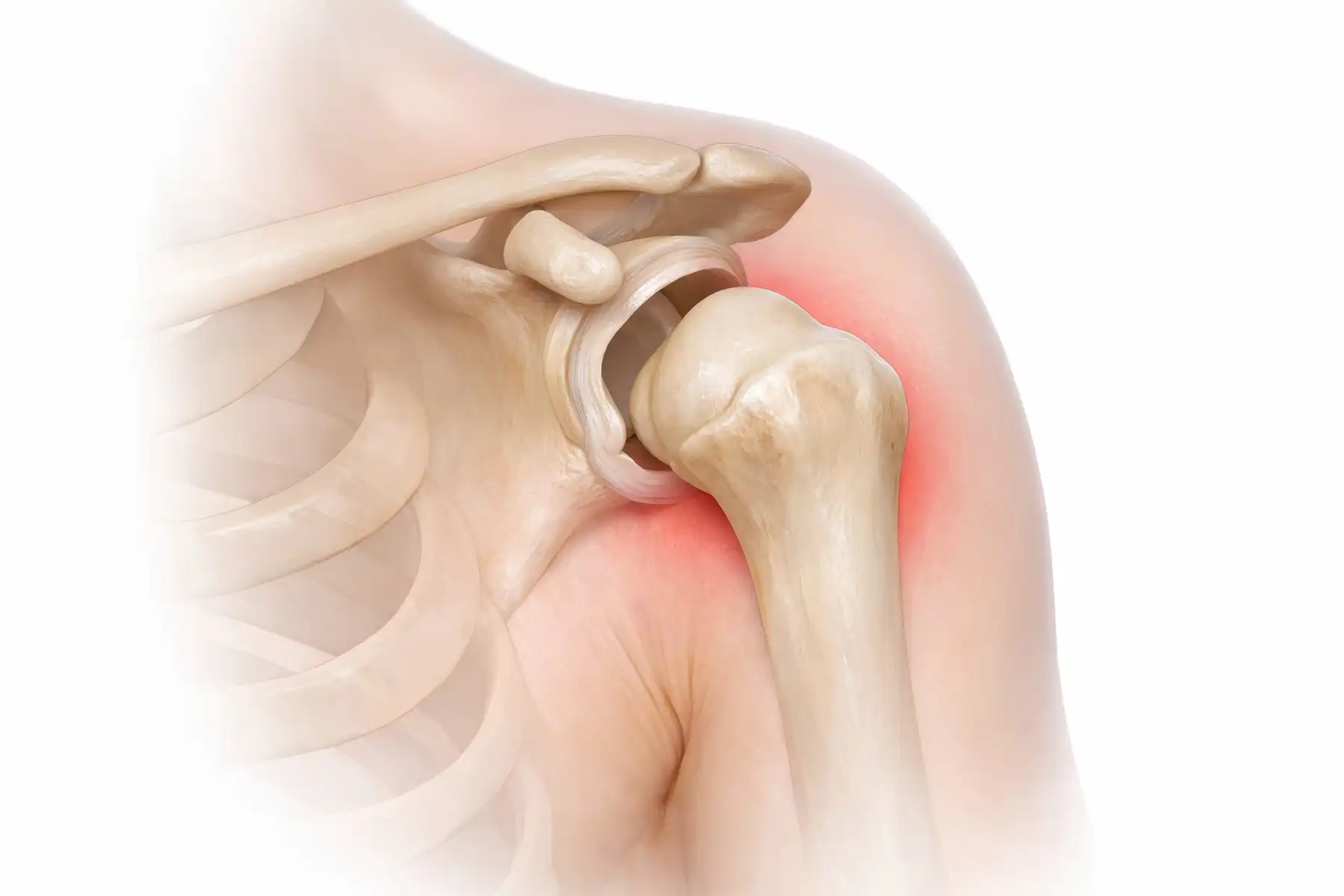 Shoulder Dislocation