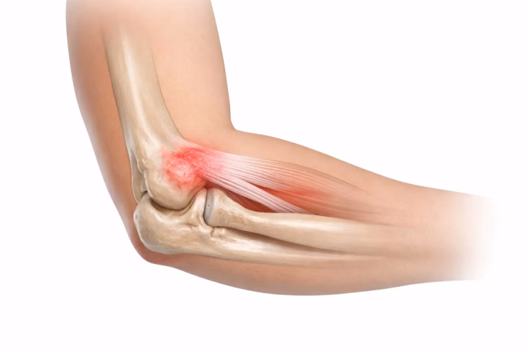Tennis Elbow
