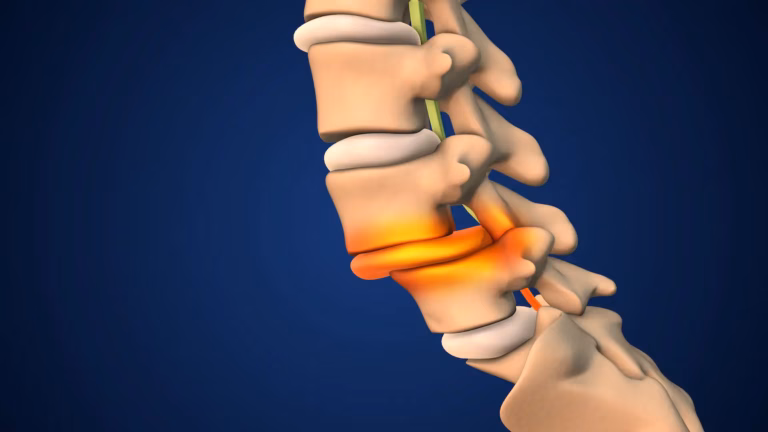 Spondylolisthesis (Slipped Vertebra)
