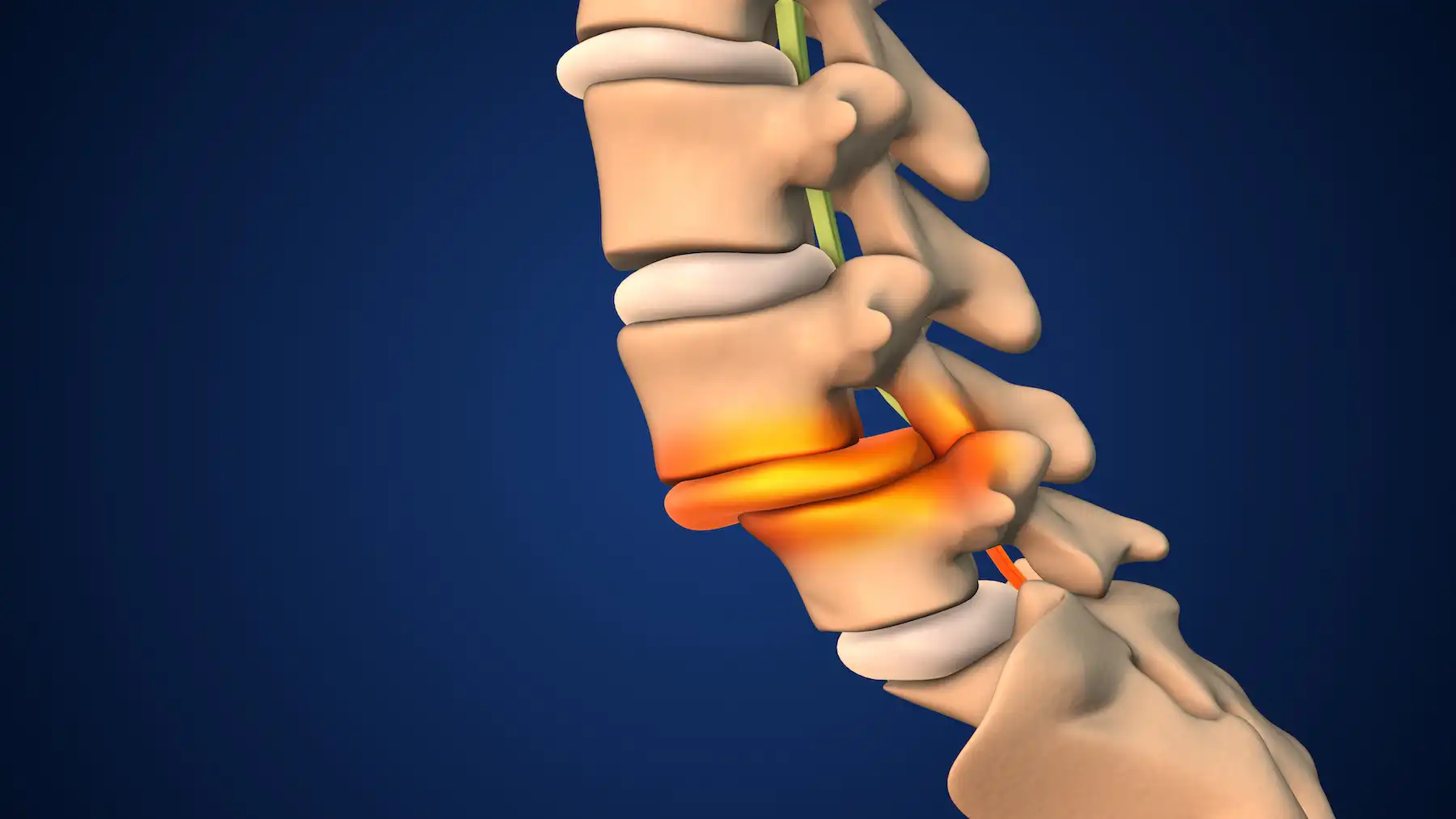spondylolisthesis