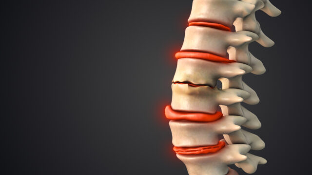 Degenerative Disc Disease