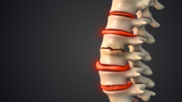 Degenerative Disc Disease (DDD)