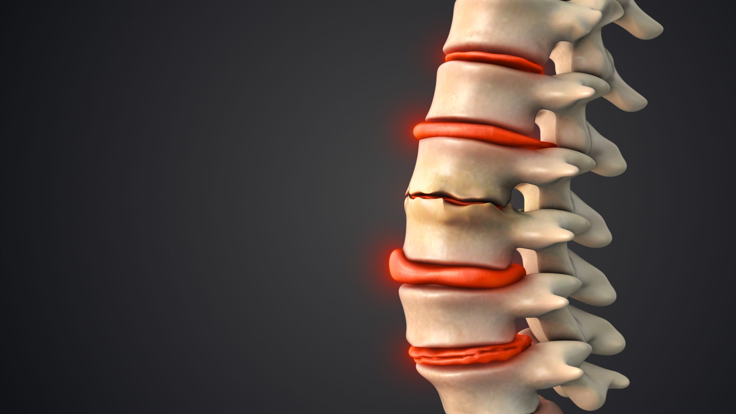 Degenerative Disc Disease