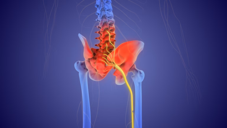 Sciatica (Shooting Leg Pain)