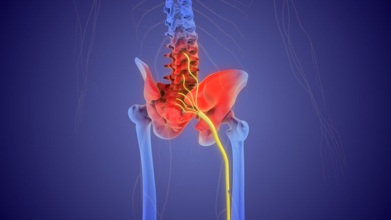 Sciatica (Shooting Leg Pain)