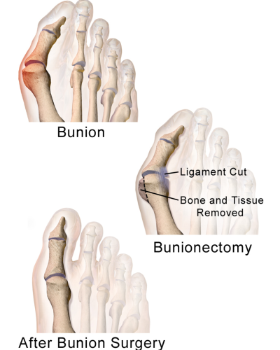 Bunionectomy